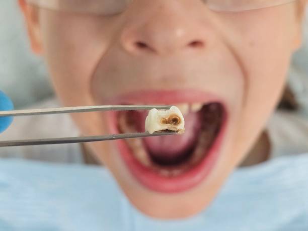 Best Chipped Tooth Repair Near Me  in Wytheville, VA